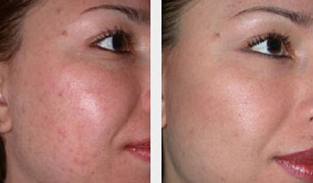 microdermabrasion before & after