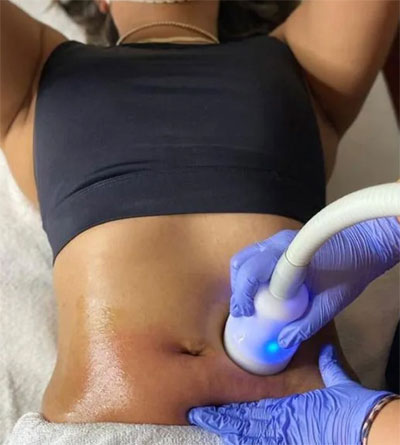 CryoTfusion slimming treatment