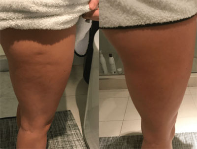 CryoTfusion toning treatment